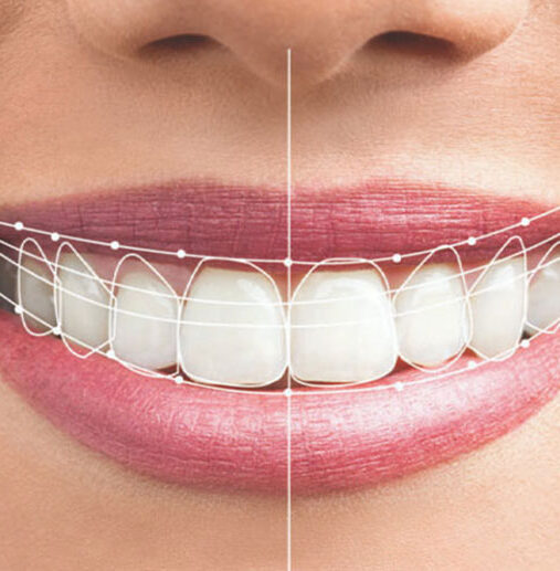 Dijital Gülüş Tasarımı