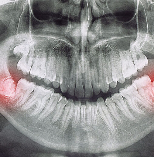20 Yaş/Gömülü Diş Çekimi