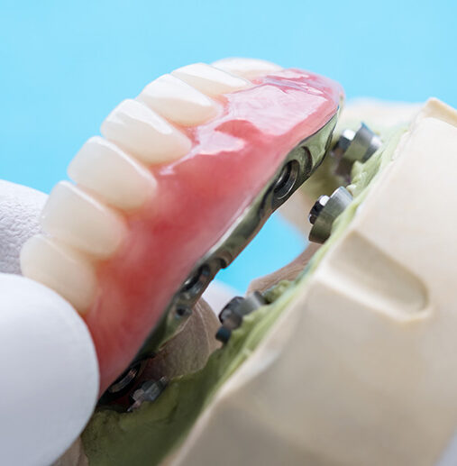 İmplant Destekli Hareketli Protezler