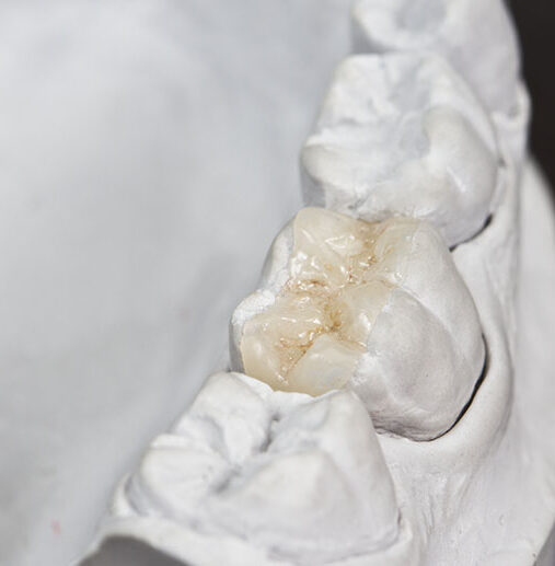 Inlay/Onlay Restorasyonlar